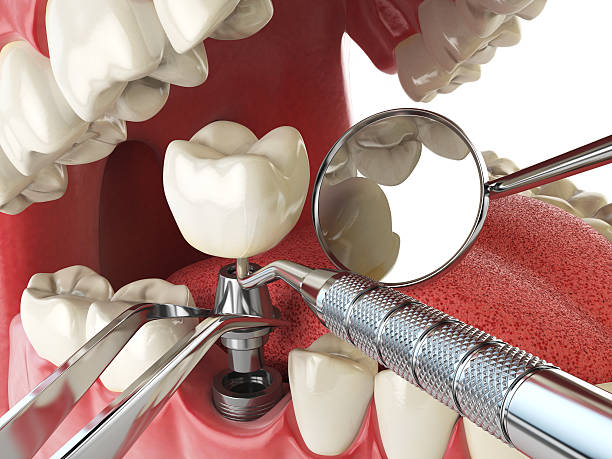 Best Root Canal Emergency Dentist  in South Fulton, GA